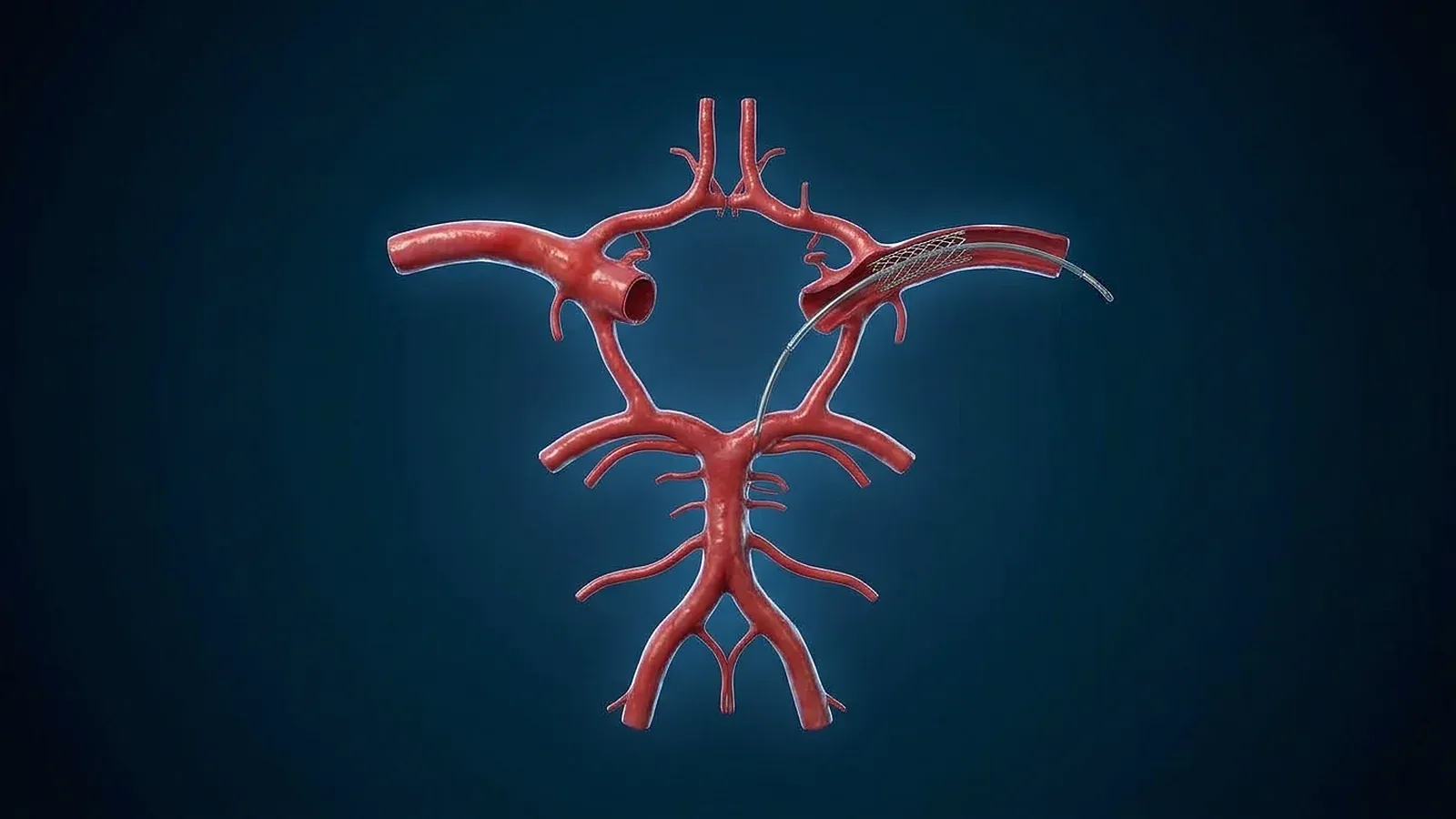 Kodierung in der Neuroradiologie