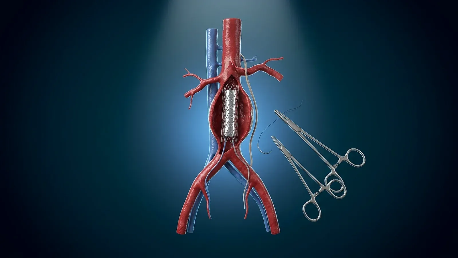 Kodierung in der Gefäßchirurgie